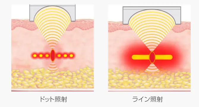 ドット照射、ライン照射図解